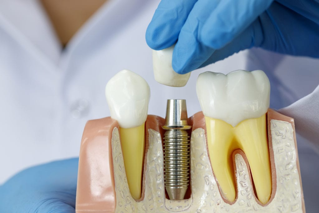 Affordable dental Implants in Garner, North Carolina for lost teeth