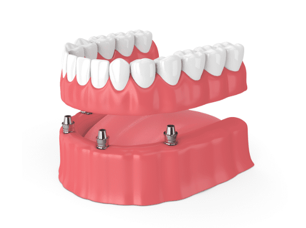 Dentures and Partial dentures in Garner, North Carolina for missing teeth