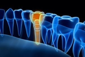 affordable dental implants in garner, north carolina