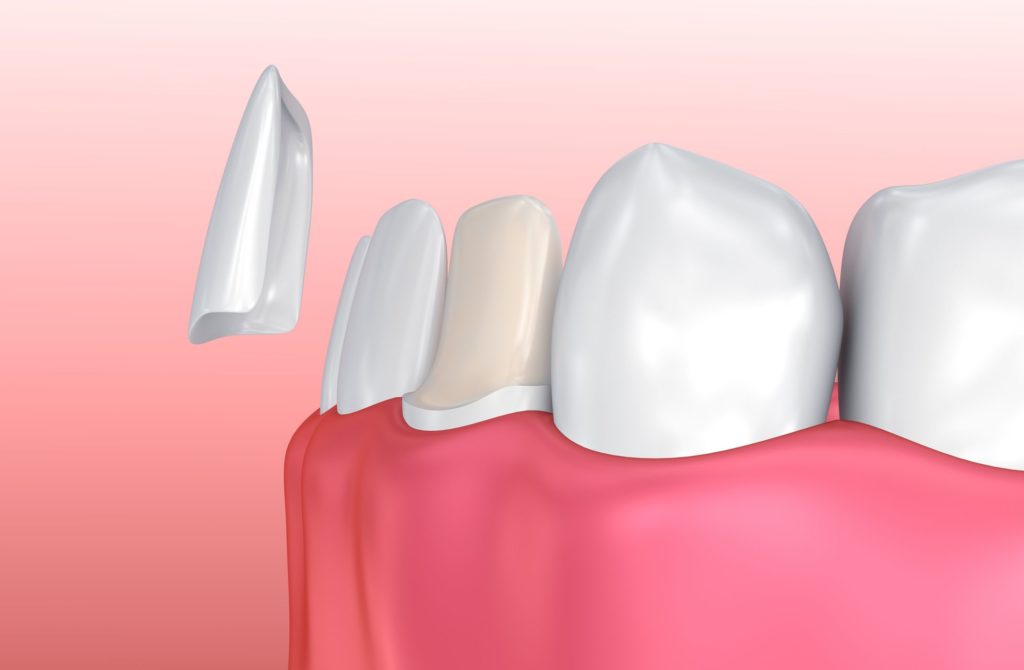 porcelain veneers boost oral health Garner North Carolina