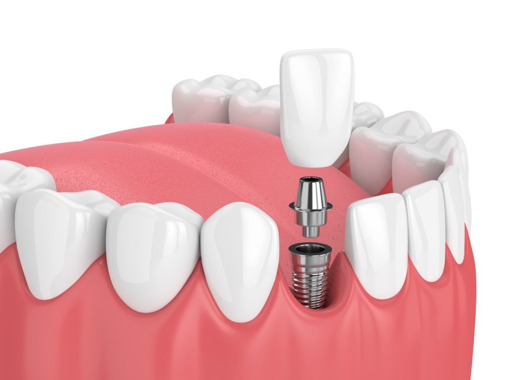 implant supported crown in Garner, NC