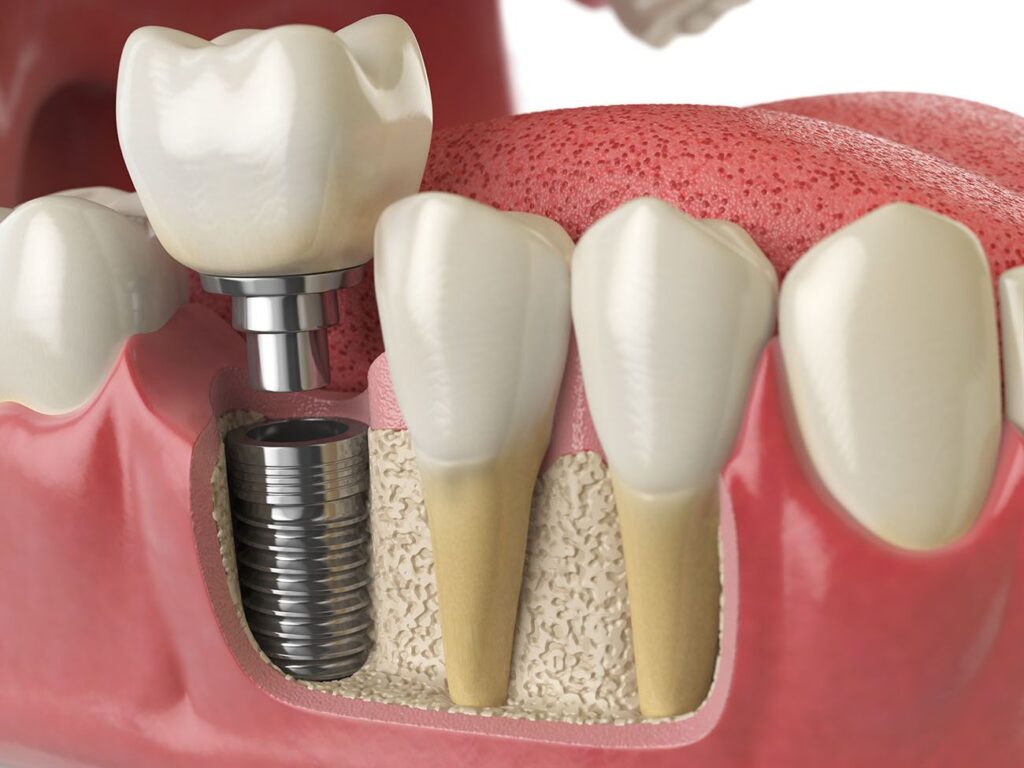 implant dentistry benefits for jaw health
