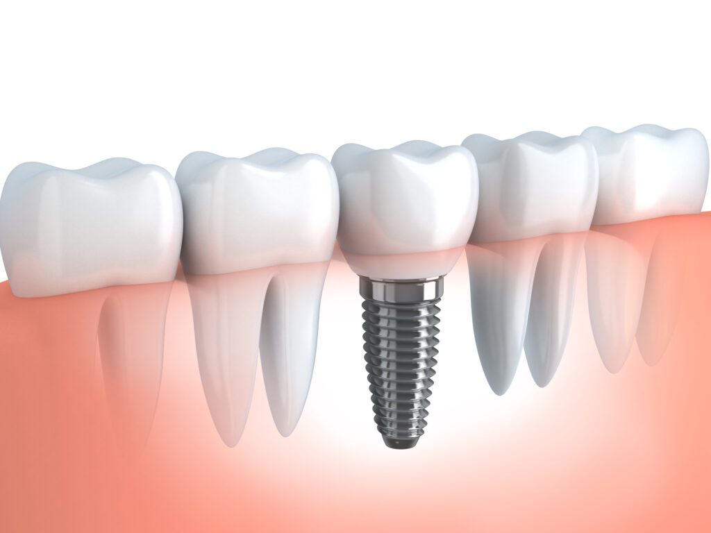 dental implants in Garner, NC