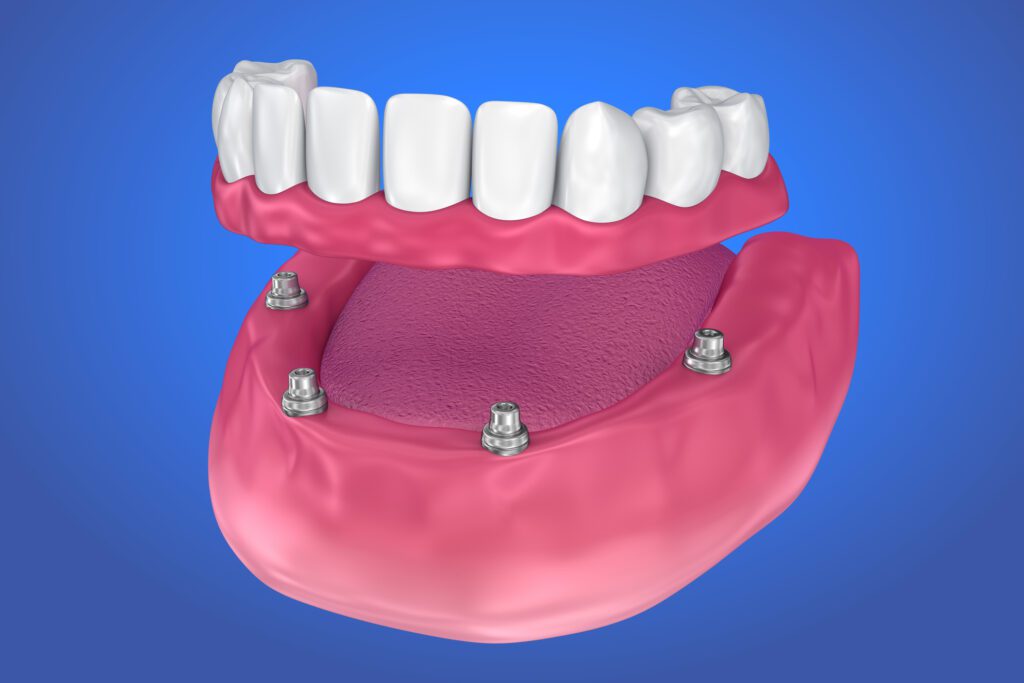 full mouth dental implants in Garner, NC