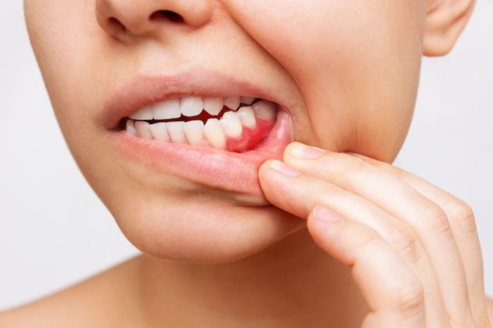 treating bleeding gums in garner, north carolina