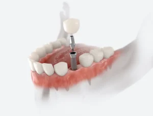When to Consider Dental Implants Garner NC