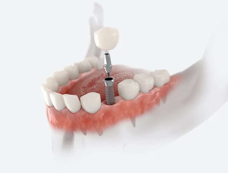 When to Consider Dental Implants Garner NC