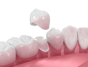 Same-Day Crowns vs. Traditional Crowns in Garner, NC