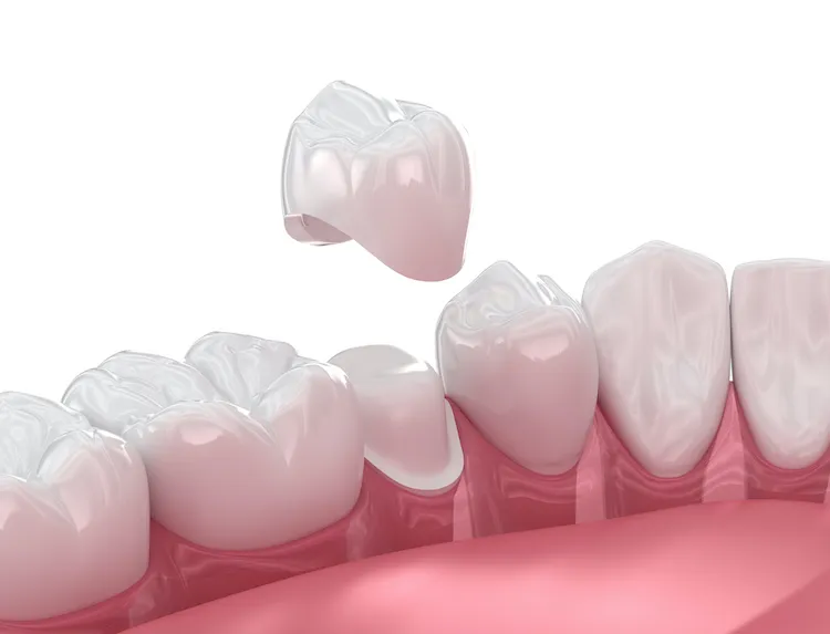 Same-Day Crowns vs. Traditional Crowns in Garner, NC